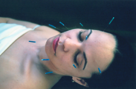 Acupuncture facelift example picture