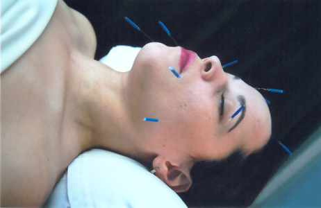 Acupuncture facelift example picture