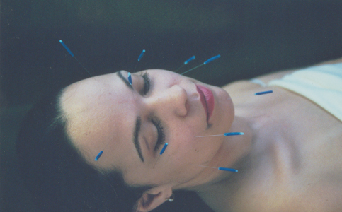 Acupuncture facelift example picture